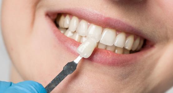 Faccette dentali come si applicano