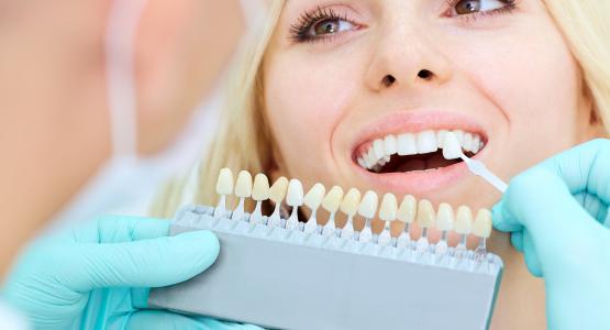 Faccette dentali