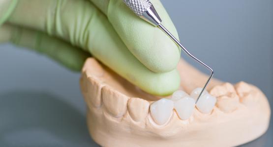Intarsio dentale o capsula