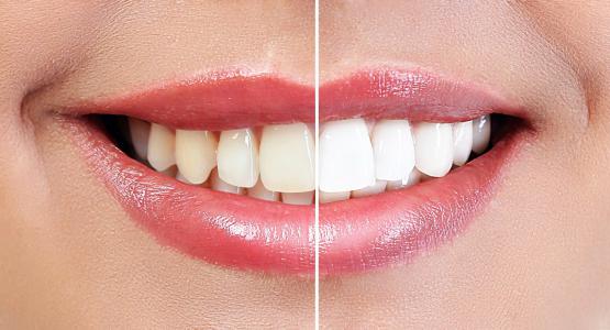 Denti più bianchi