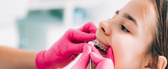 Ipomineralizzazione denti bambini