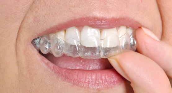 Denti trasparenti