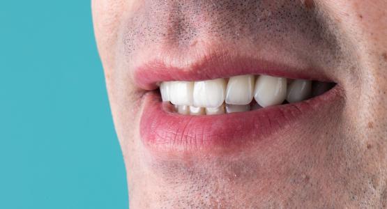 Denti gialli rimedi