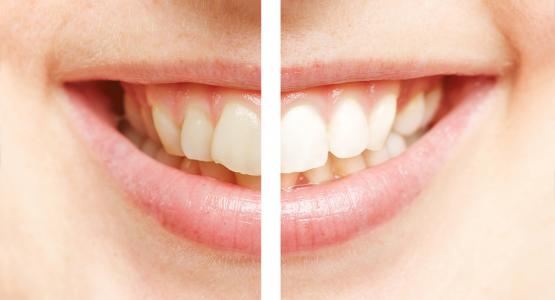 Denti gialli