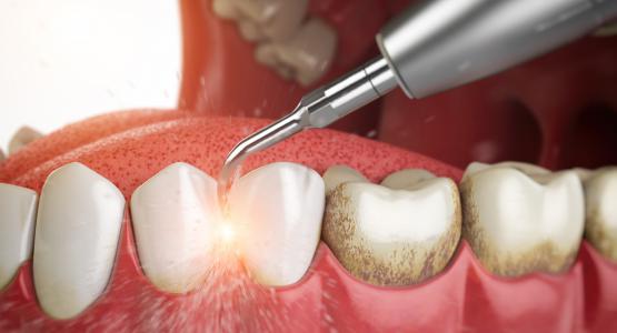 Idropulsore dentale