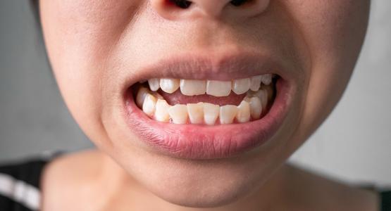 Macchie bianche sui denti