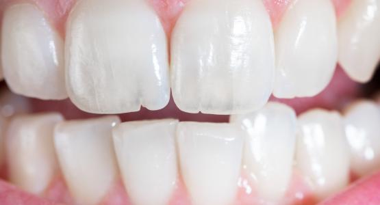 Puntini bianchi sui denti