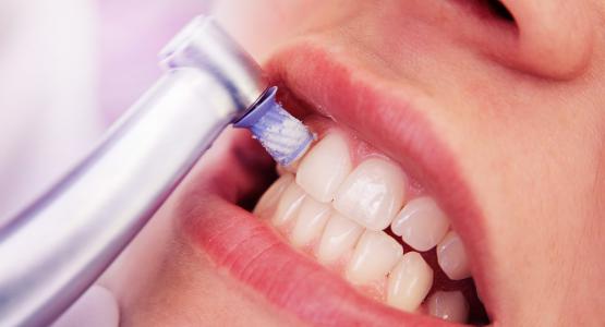 Tartaro denti che si stacca