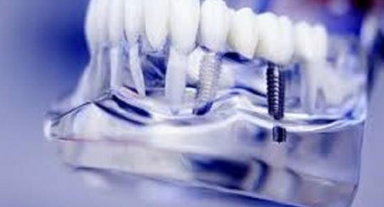 Implantologia dentale Alessandria