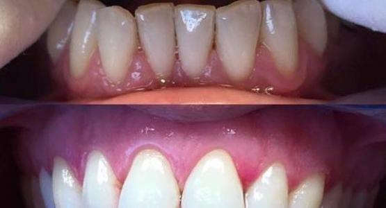 Sbiancamento denti Bari