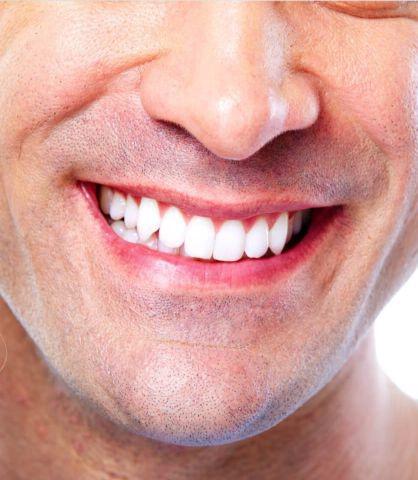 Sbiancamento denti Bergamo 