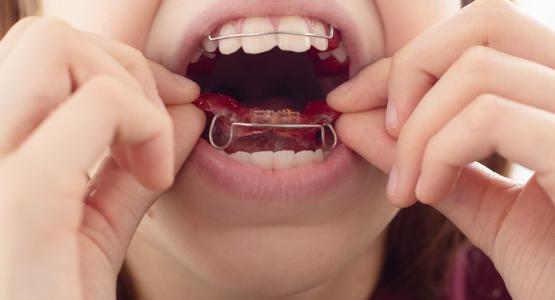 Apparecchio denti costo