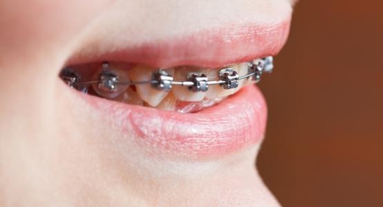 Apparecchio denti
