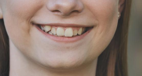 Denti storti adulti