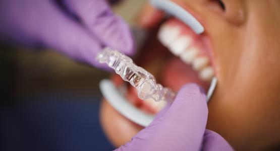 Invisalign full