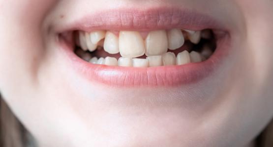 Malocclusione dentale