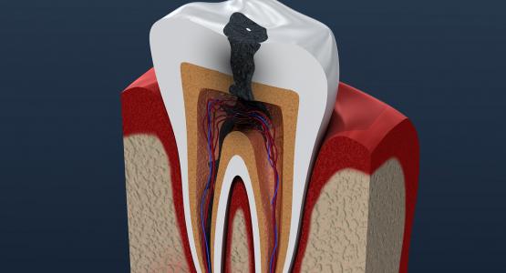 Dente nero