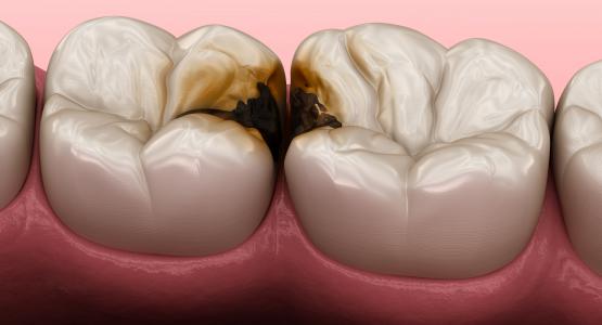 Dente rotto nero