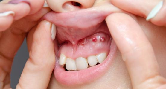 Granuloma dente devitalizzato e incapsulato