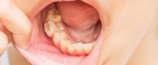 Affollamento dentale grave