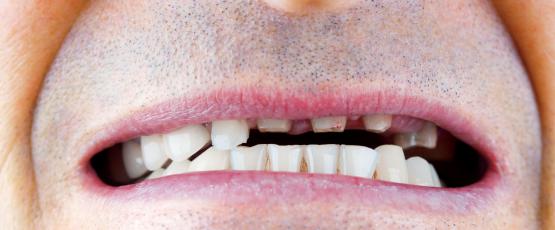 Come nascondere un dente mancante