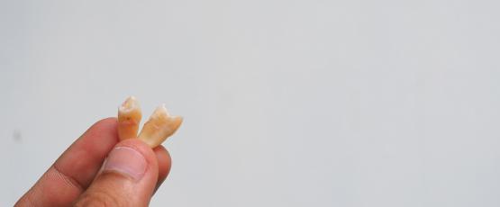 Cosa mangiare dopo estrazione dente