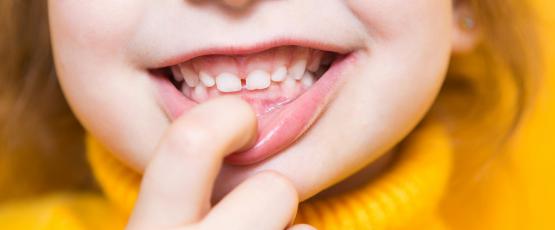 Dente da latte dondola ma non cade