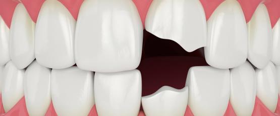 Dente rotto