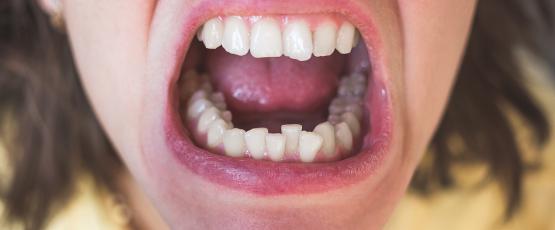 Denti accavallati