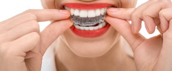 Silicone ortodontico