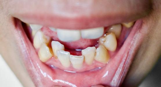 Affollamento dentale grave