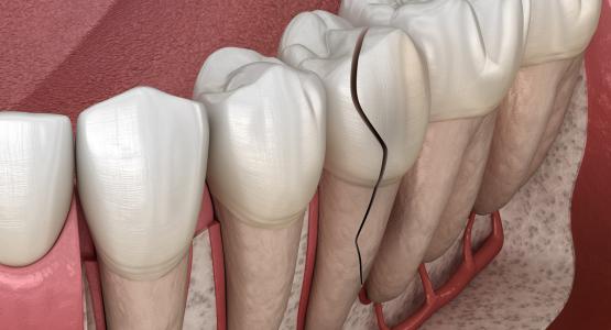 Come nascondere un dente rotto