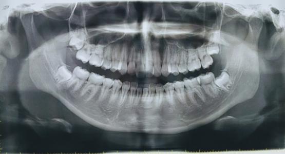 Dente del giudizio