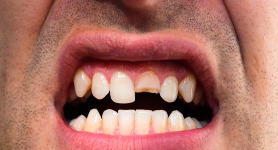 Dente rotto