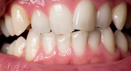 Denti accavallati