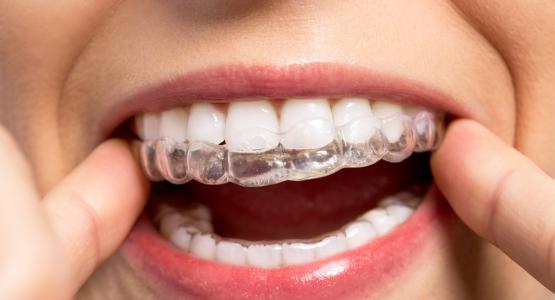 Silicone ortodontico