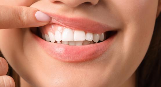 Bordo nero tra dente e gengiva