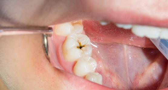 Dente marcio