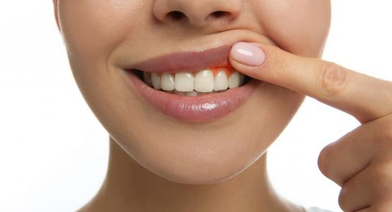 Gengive gonfie e doloranti rimedi naturali 