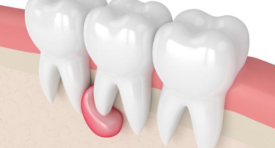 Granuloma dentale è pericoloso