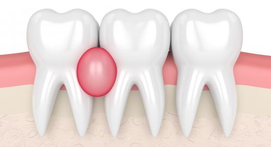 Granuloma dentale