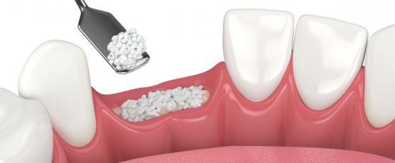Innesto osseo dentale controindicazioni