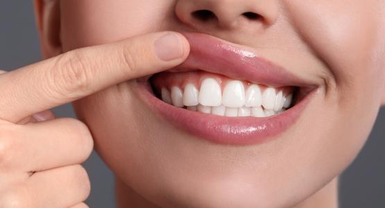 Denti fissi in 6 ore