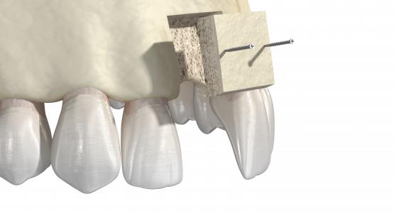 Innesto osseo dentale complicanze