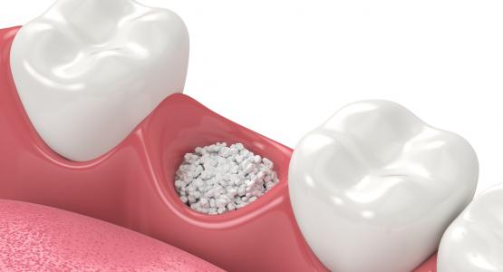 Innesto osseo dentale controindicazioni