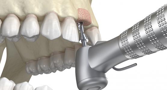 Innesto osseo dentale tempi di guarigione